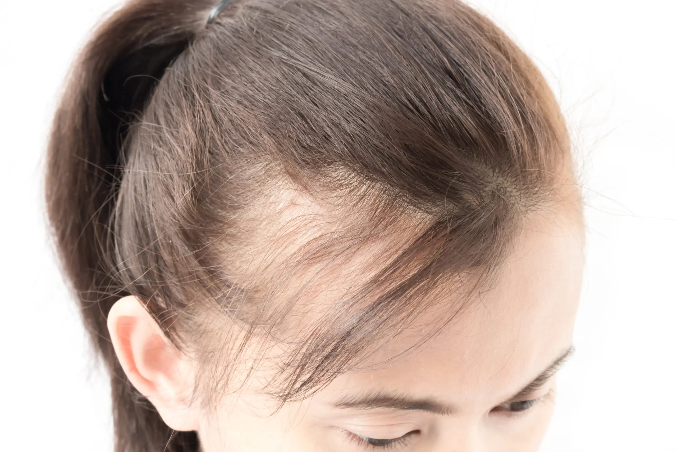 Hair Loss in Women: Causes and Treatment - EVEXIAS Health Solutions